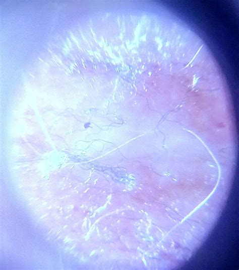 These Morgellons fibers are tiny at 240x magnification, they would ...