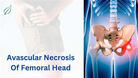 Avascular Necrosis of Femoral Head: Causes, Symptoms, Treatment | Best Back Pain, Slip Disc ...