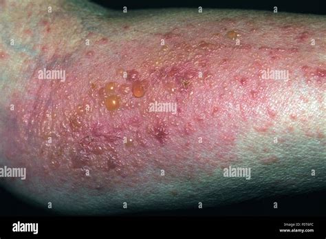 Poison ivy blisters on a woman's arm Stock Photo - Alamy