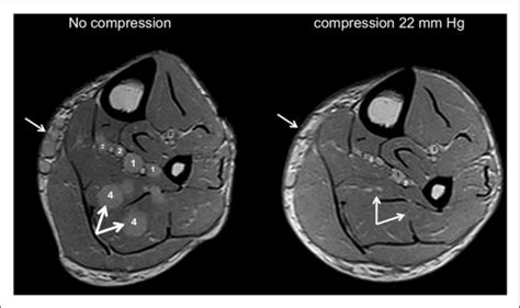 Comparison of MRI slices at the mid calf showing the anatomy with an IP ...