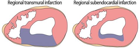 Acute Coronary Syndrome (ACS) - Clinician Revision