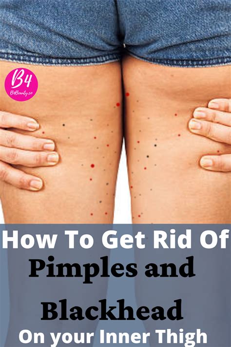 Why do you get pimples and blackheads on inner thighs? in 2021 | Inner thigh bumps, Inner thigh ...