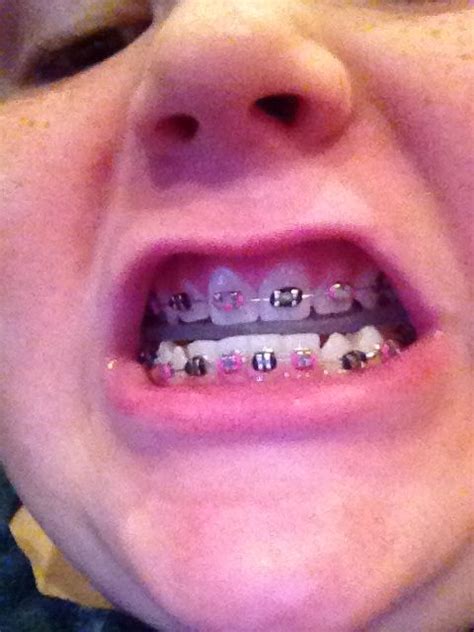 How to make fake braces thes are real braces get a paper clip beads stick the beads though the ...