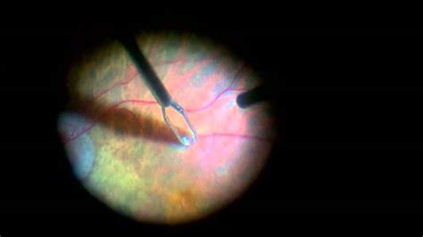 Macular Hole Surgery Recovery - newdesignhouse9