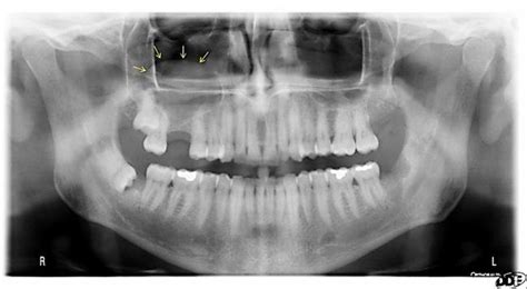 Mucous Retention Cyst Maxillary Sinus X Ray