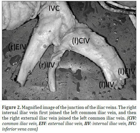 Bilateral malrotated kidney with major venous variant: a cadaver case report