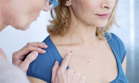 Should I Seek Treatment if My Mole Itches?: Northstar Dermatology: Dermatology