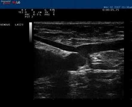 Phlebology- Biosound Esaote MyLab 25 SFJ Venous Ultrasound - YouTube