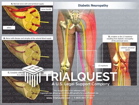 Diabetic Neuropathy - TrialExhibits Inc.