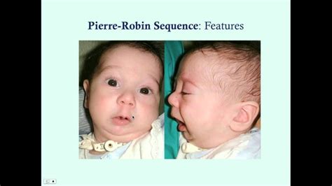 Pierre Robin Sequence - CRASH! Medical Review Series - YouTube