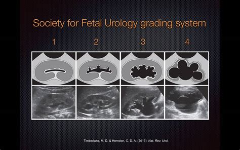 Grading Hydronephrosis on Bedside Ultrasound - YouTube