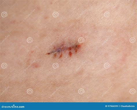 Surgical Wound Stitches Removed Stock Image - Image of removed, wound ...