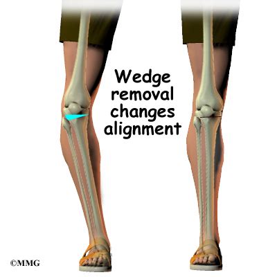 Tibial Osteotomy - eOrthopod.com