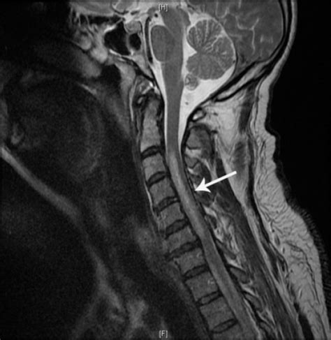 Spinal Cord Infarction And Differential Diagnosis Rad - vrogue.co