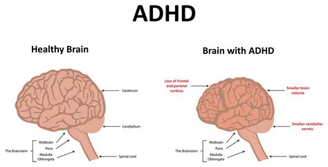 Biology Of Adhd Brain - Brain Mind Article