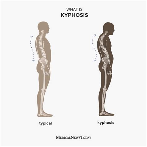 Kyphosis: Symptoms, causes, exercises, and more