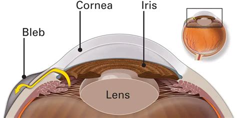 Glaucoma Treatment - American Academy of Ophthalmology