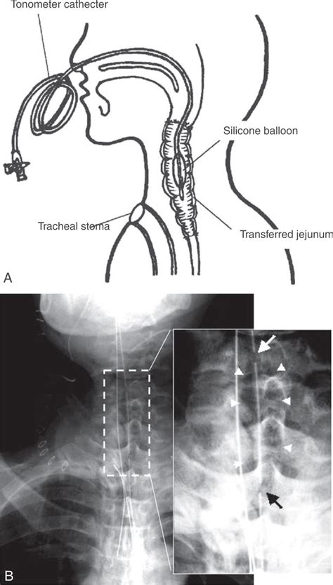 A) Tonometry catheter was inserted through the nostril during surgery ...