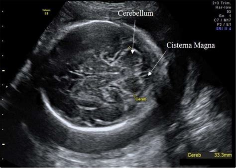 Cisterna Magna Ultrasound