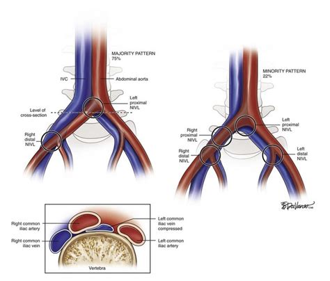 Iliofemoral Venous Occlusive Disease | Thoracic Key