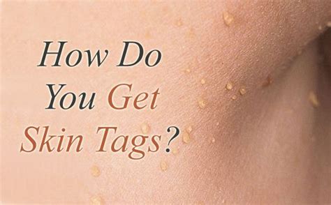 What Causes Skin Tags and How Do You Get Them? | Causes of skin tags ...