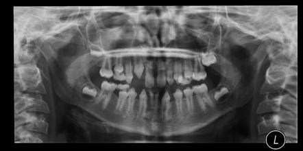 Ectodermal Dysplasia Syndrome