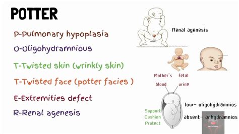 potter sequence mnemonic - YouTube