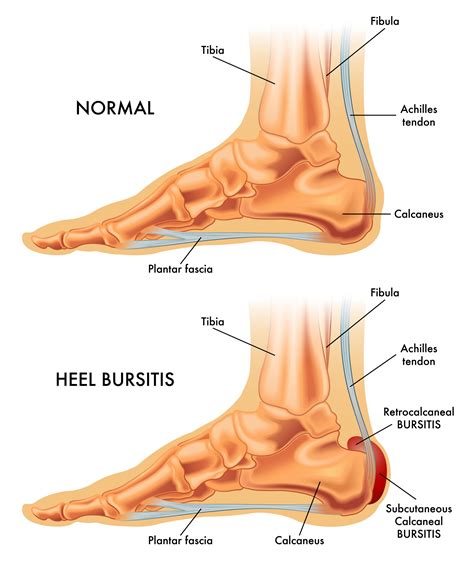 Bursitis Causes & Treatment – My FootDr