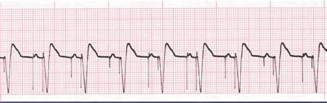 ekg