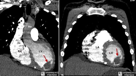 Learning Radiology - Left, Ventricular, Thrombus, LV, clot