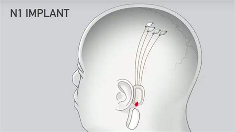 Thought-Controlled Implants Just Became A Lot Easier To Acquire | GIANT ...