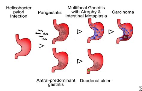 Gastritis, Atrophic