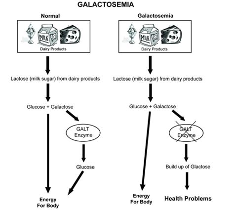 Galactosemias; Deficiencia de UDPglucosa-Hexosa-1-Fosfato Uridililtransferasa; Enfermedad por ...