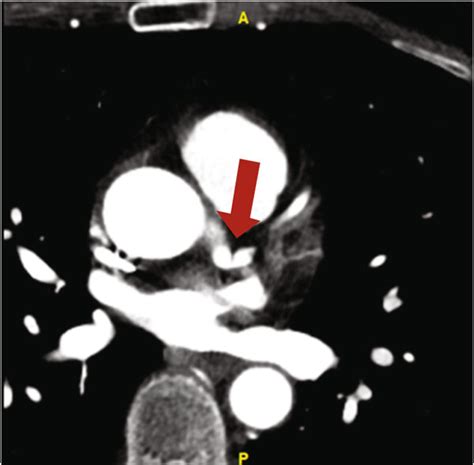 (a and b) Coronary CT angiography demonstrating proximal left... | Download Scientific Diagram