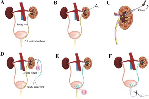 Main steps of TJIU technique: a Insert the ureteral catheter with... | Download Scientific Diagram