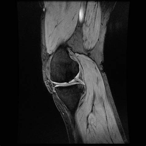 MFC full-thickness chondral fissure. Source: CKC UK. www.kneeclinic.info