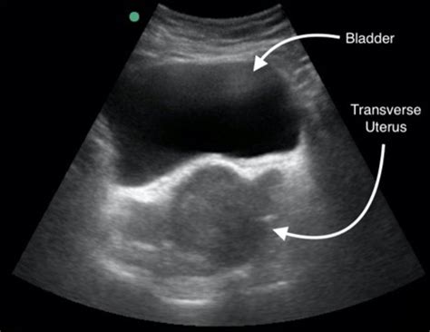 Transabdominal Pelvic Ultrasound | sexiezpix Web Porn