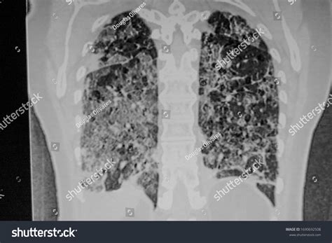 Chest Ct Scan Novel Coronavirus Covid19 Stock Photo 1690692508 ...