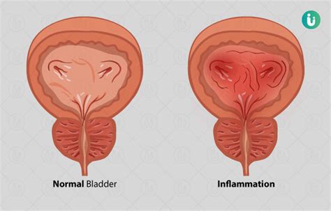 Cystitis: symptoms, causes, treatment, medicine, prevention, diagnosis