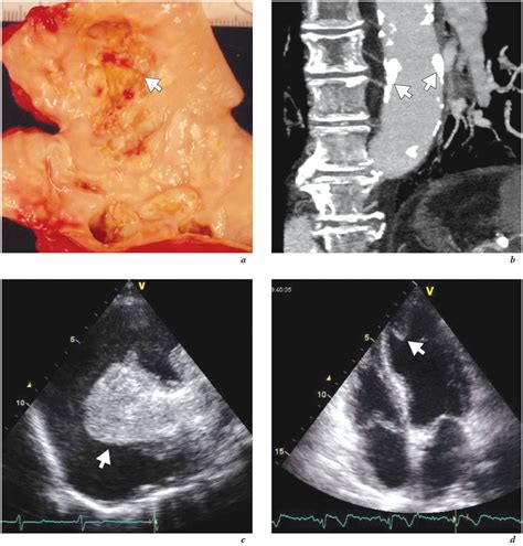 Cerebral complications in conventional coronary bypass graft surgery