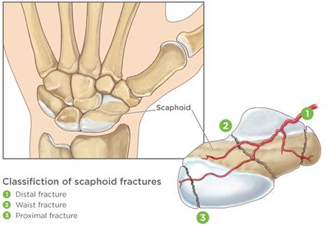 Scaphoid fracture causes, symptoms, diagnosis, treatment & revovery time