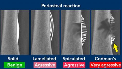 The Radiology Assistant : Bone tumors - Differential diagnosis