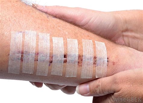 Micropore Tape v Duct Tape? And Other (Wiser) Adhesive Medical Solutions