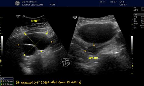 Case 28: Adnexal Cyst ~ Imaging Study