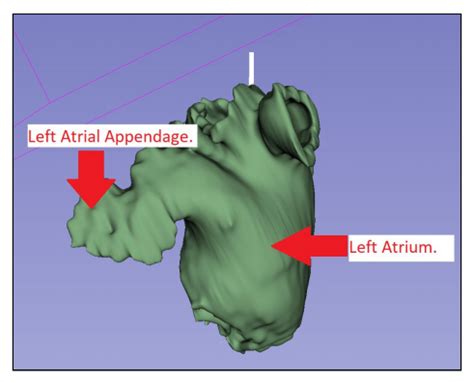 3D Printing the Left Atrial Appendage for Better Closure Procedures in Surgery - 3DPrint.com ...