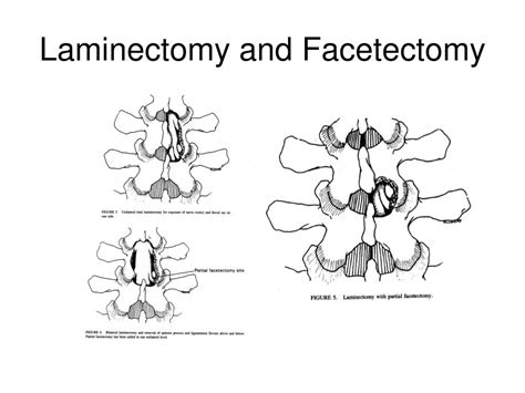 PPT - Decompression Surgery PowerPoint Presentation, free download - ID ...