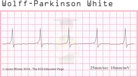 ECG Educator Blog : Atrial Rhythms