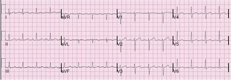 Dr. Smith's ECG Blog: Dynamic T-wave inversion (apparent Wellens' waves ...