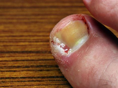 Ingrown Toenail Treatment at MD First Primary & Urgent Care