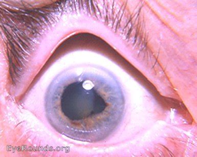 Ectropion uveae. EyeRounds.org: Online Ophthalmic Atlas